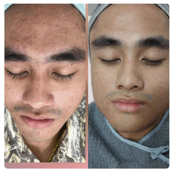 รักษารอยแดง จากสิว เร่งด่วน