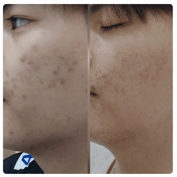 แก้สิว อักเสบ